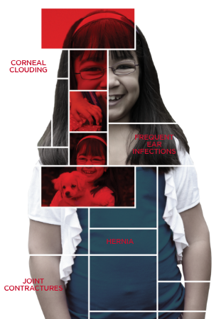 A girl diagnosed with MPS 1 disease